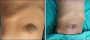 Umbilical Hernia Repair