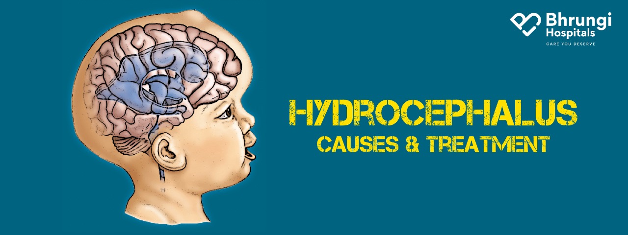 Hydrocephalus – Causes & treatment – Bhrungi Hospitals