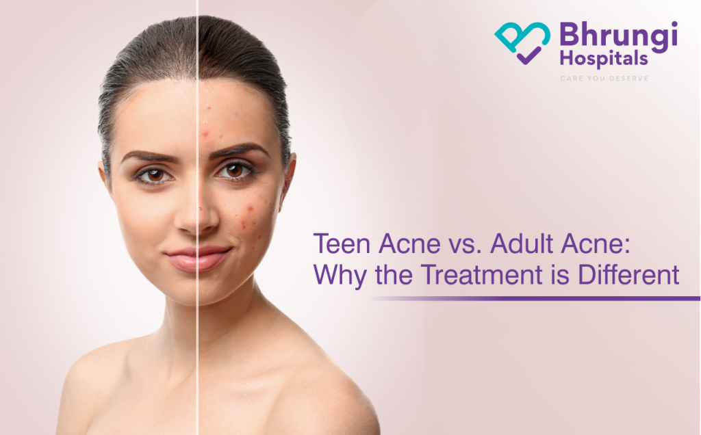 teen acne