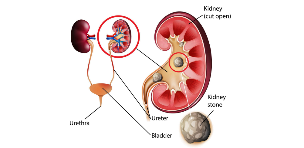 Kidney stones